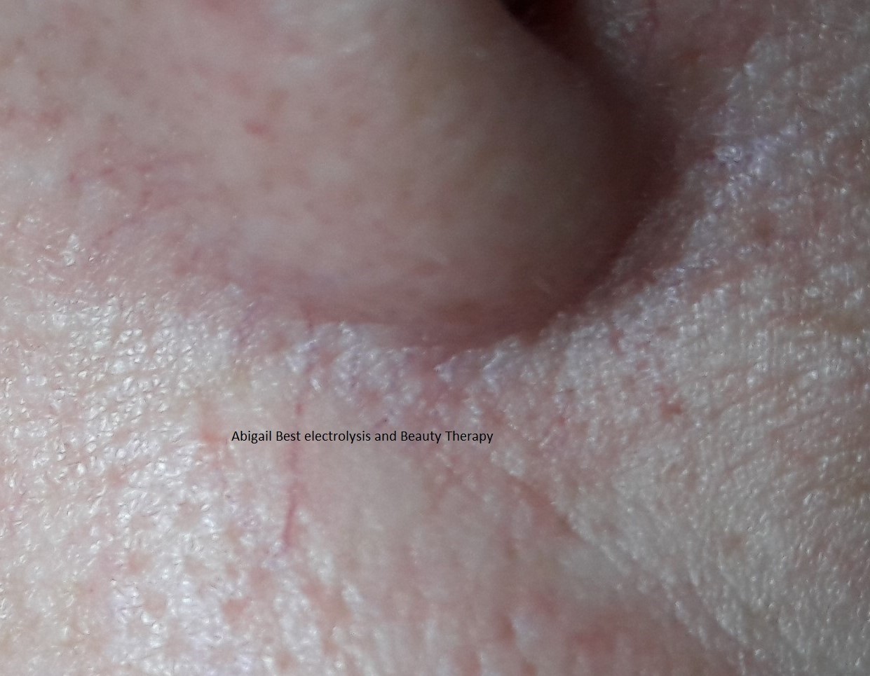 image of a red vein near the nose