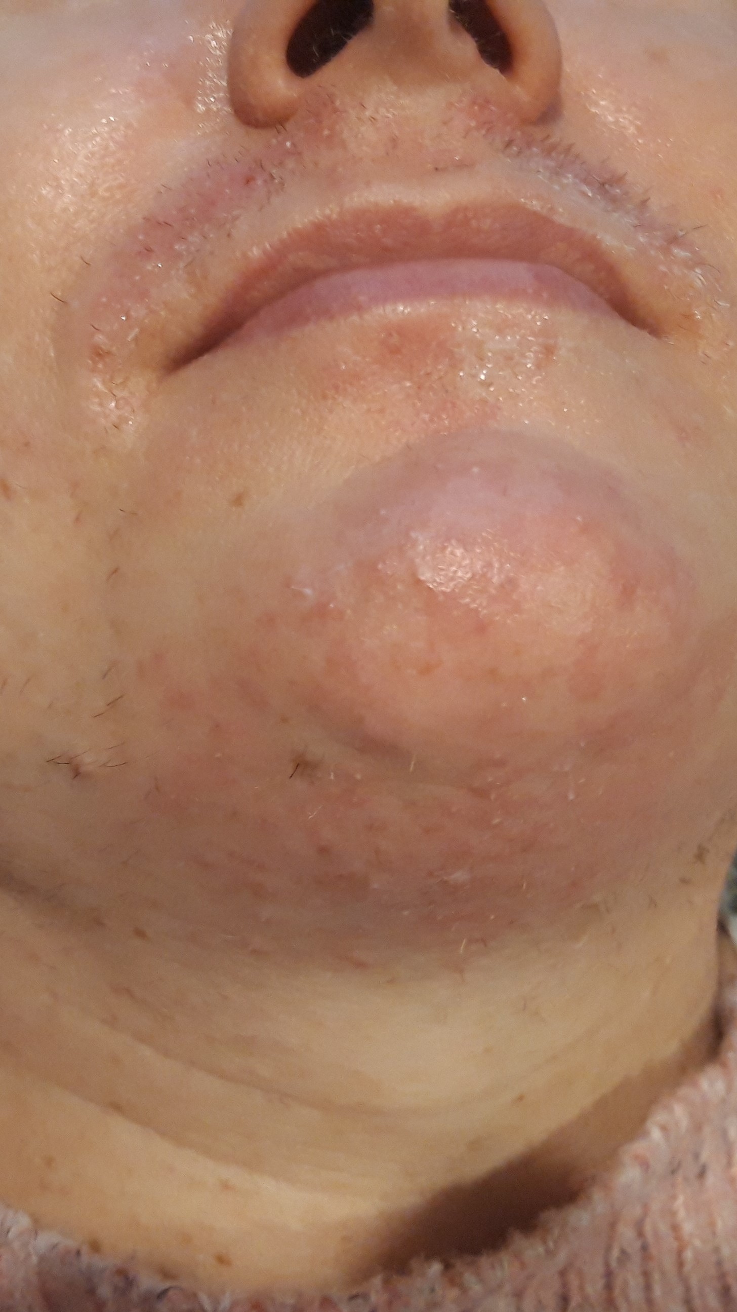 Image of Electrolysis Hair Removal on the Upper Lip, Chin and Neck
