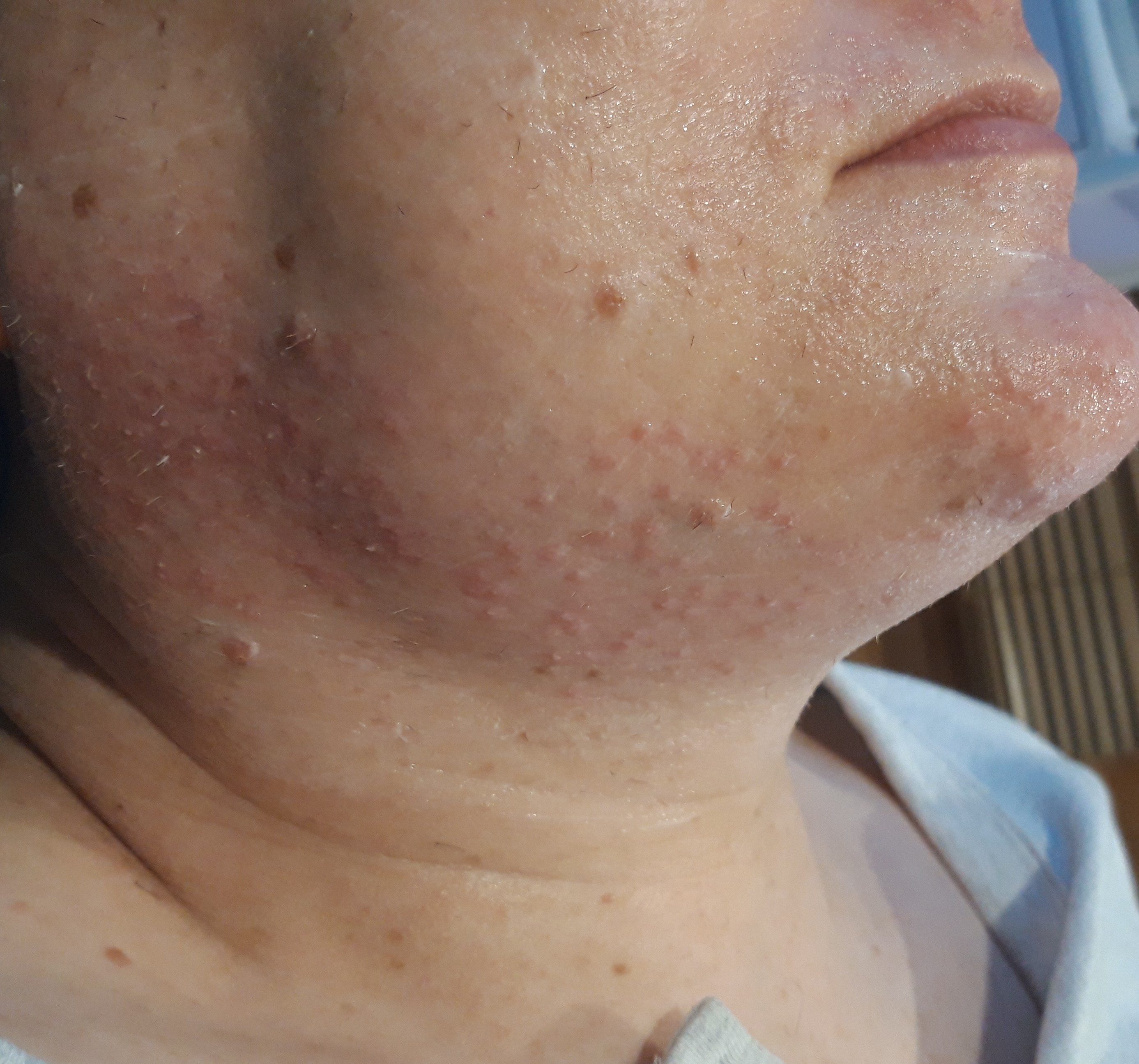 Image of Electrolysis Hair removal on the sides of the face.