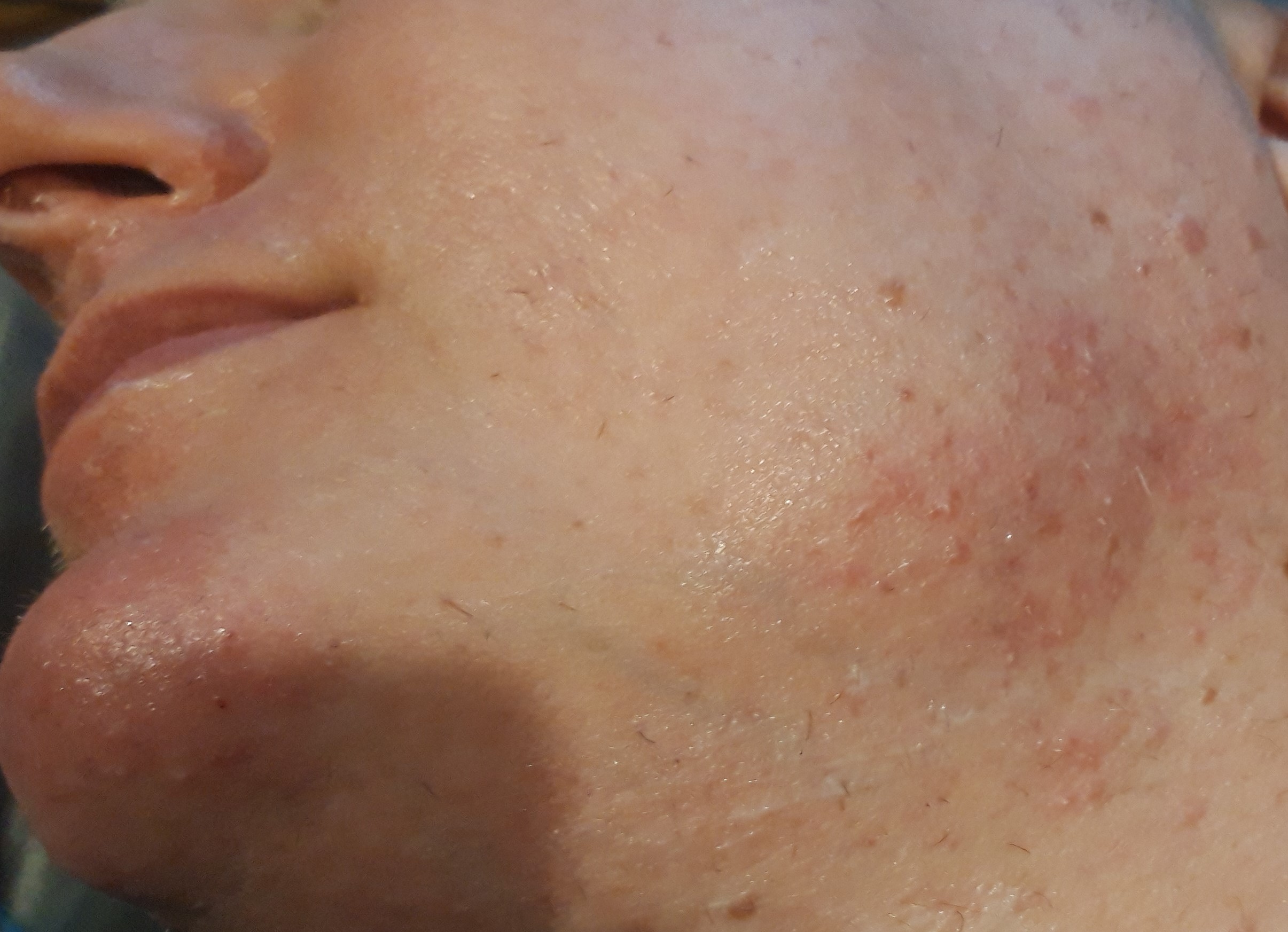 Electrolysis Hair Removal on the sides of the Face