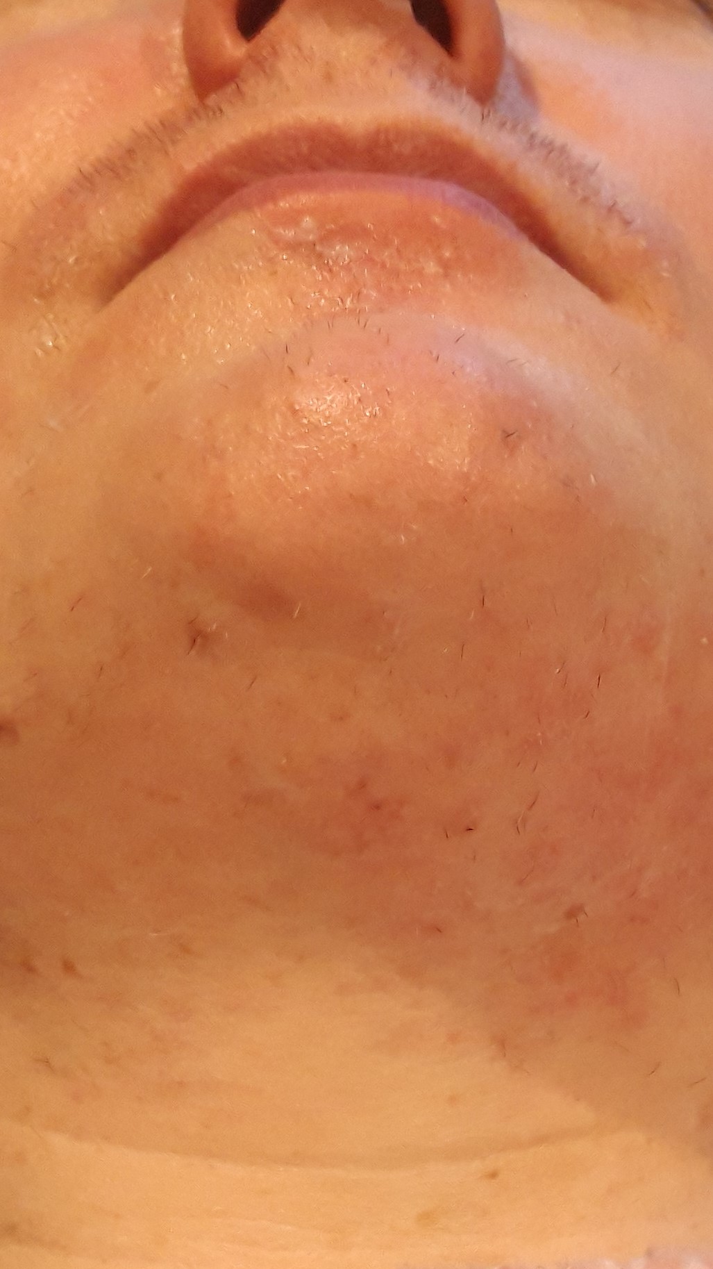 Image of Electrolysis Hair Removal on the Upper Lip, Chin and Neck