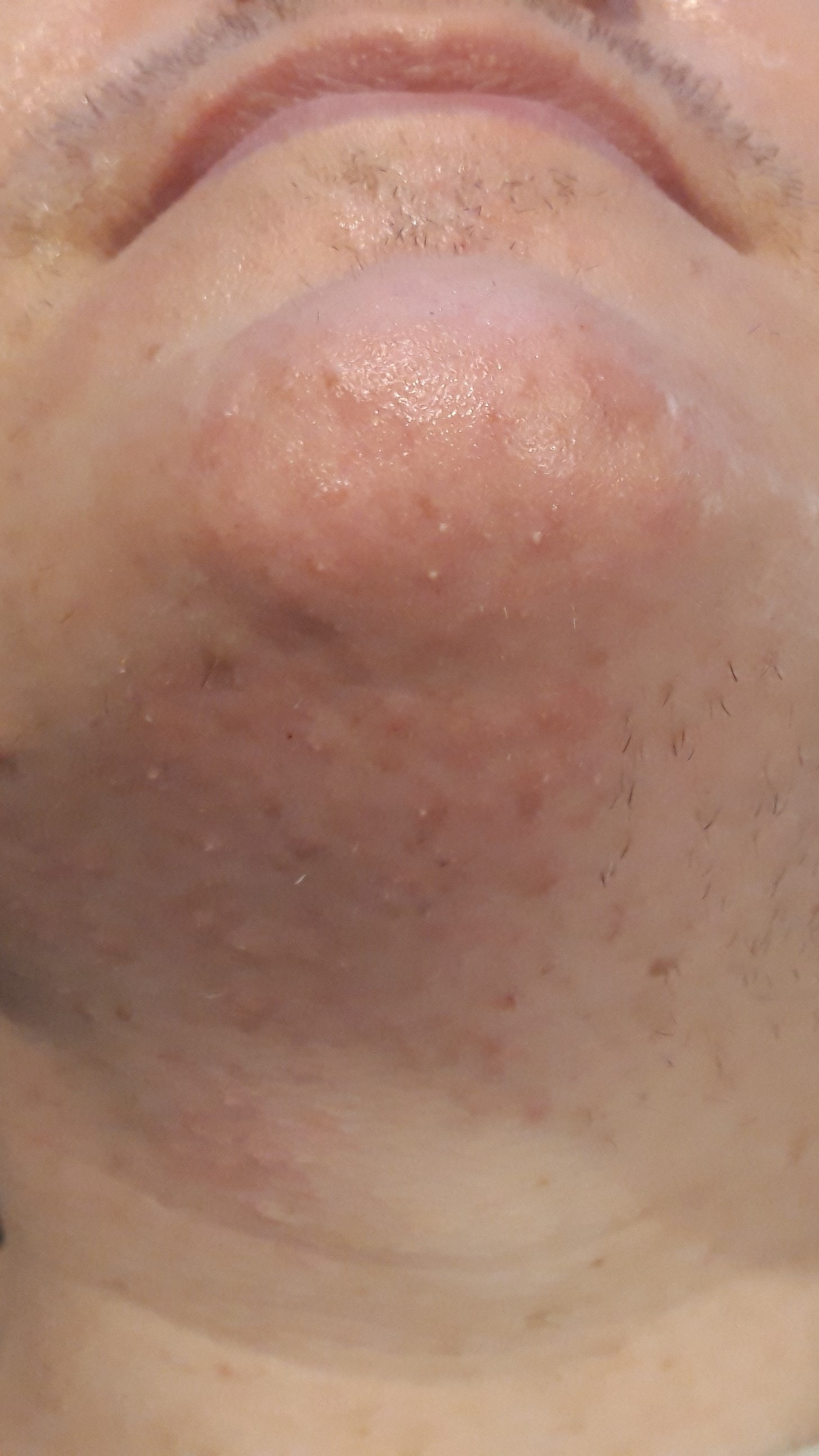 Image of Electrolysis Hair Removal on the chin and neck