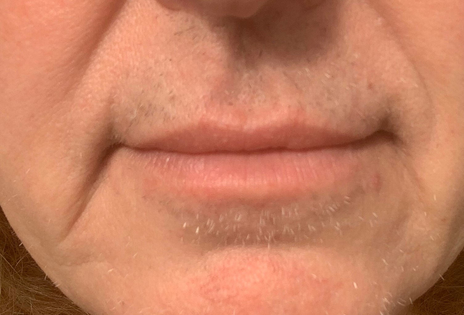 image of hairs on the lower face after 7 electrolysis treatments