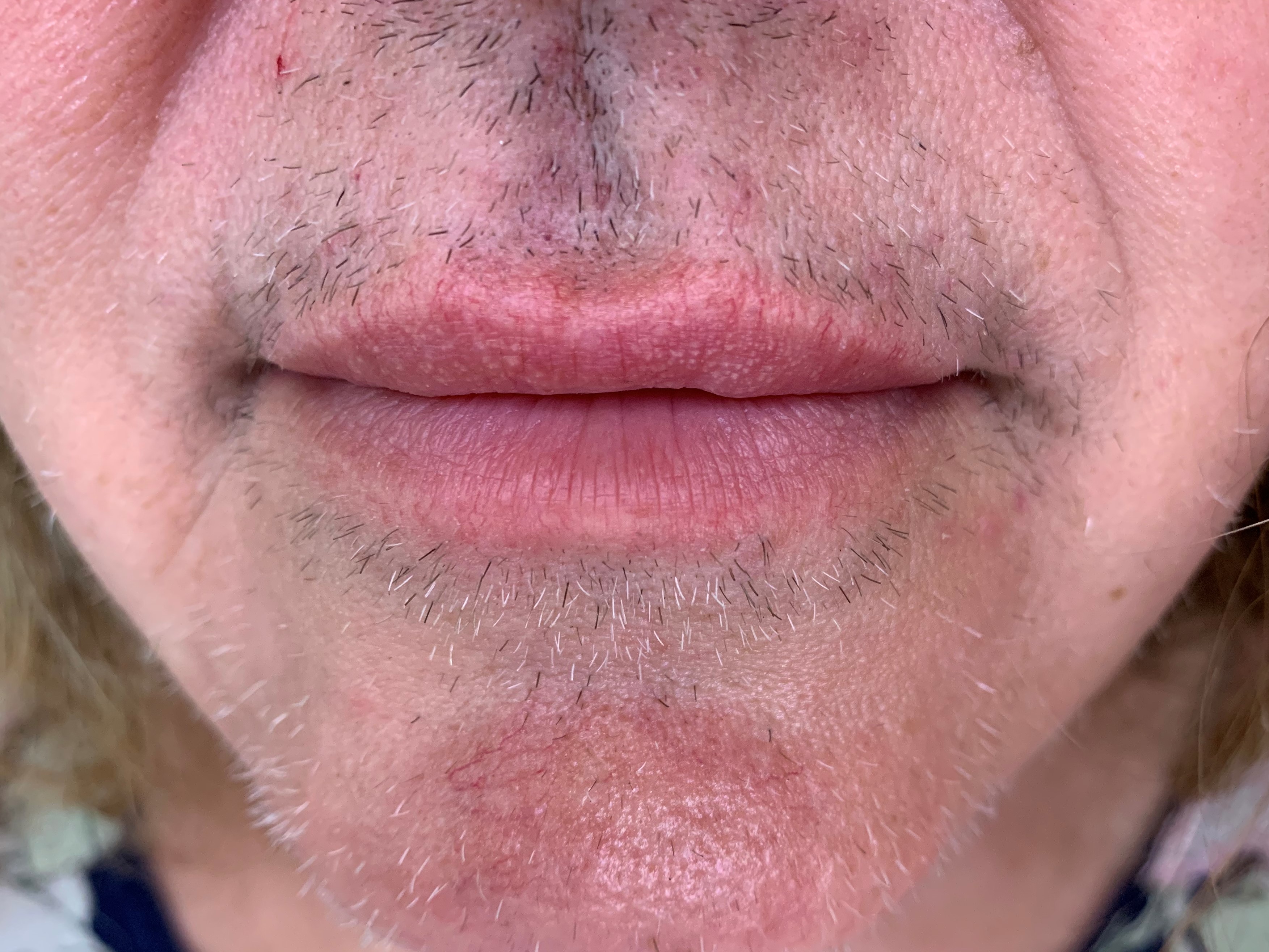 image of hairs on the lower face after 2 electrolysis treatments