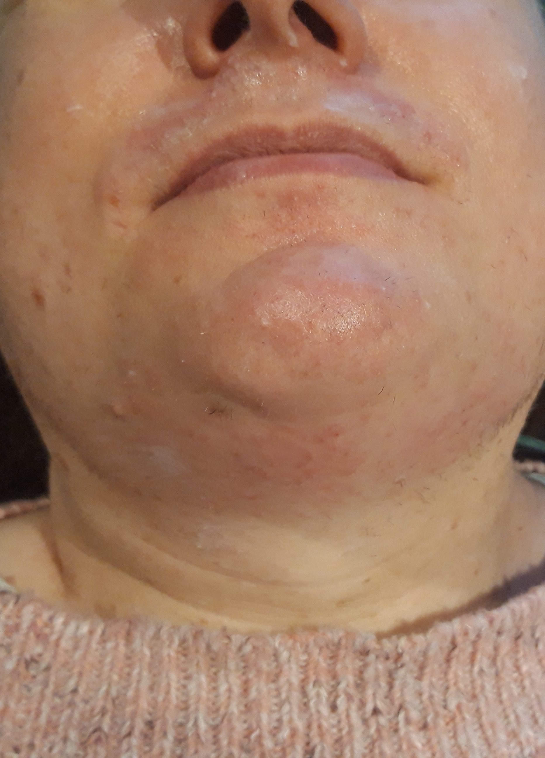 Image of Electrolysis Hair Removal on the Upper Lip, Chin and Neck