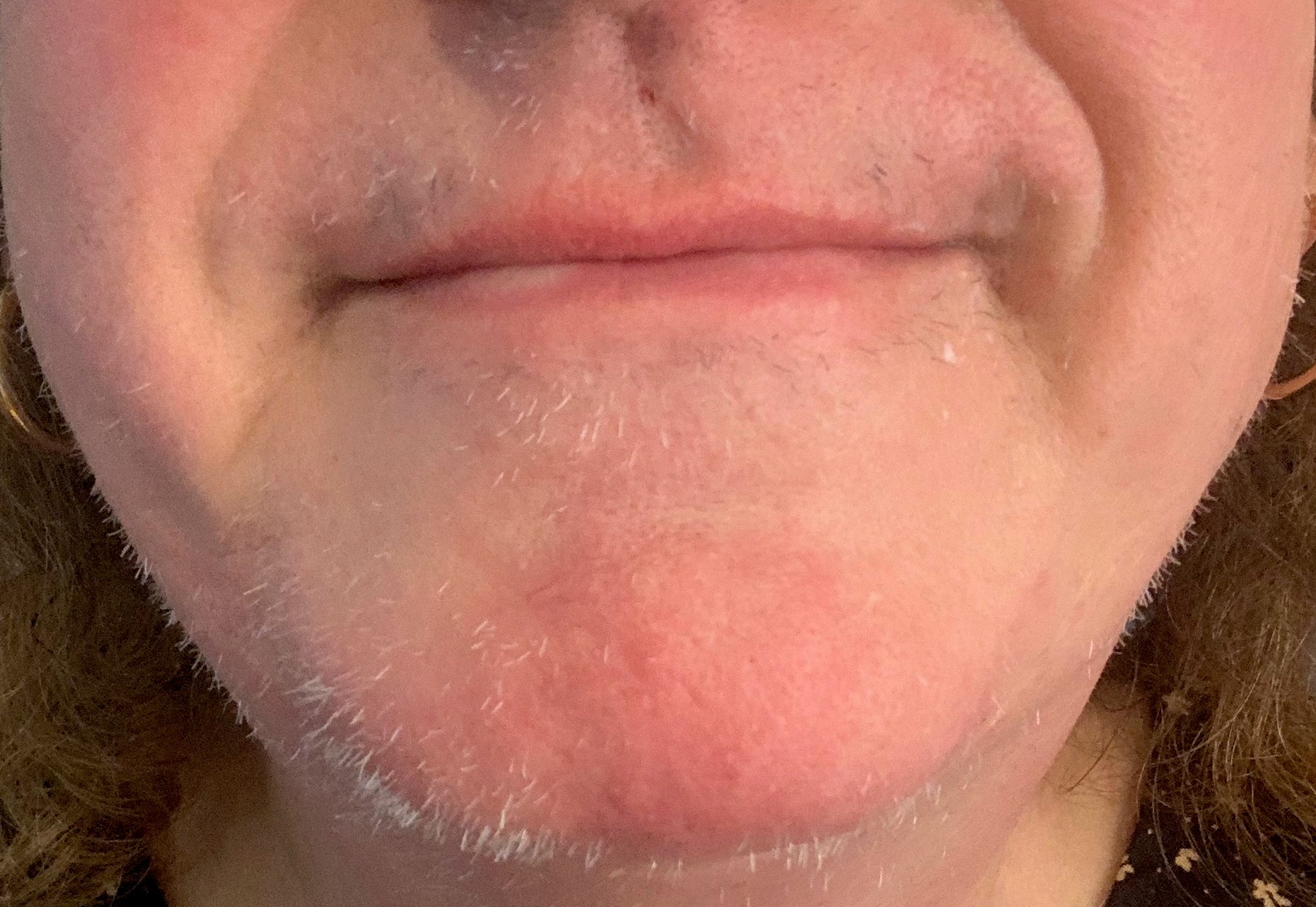 image of hairs on the lower face after 1 electrolysis treatment