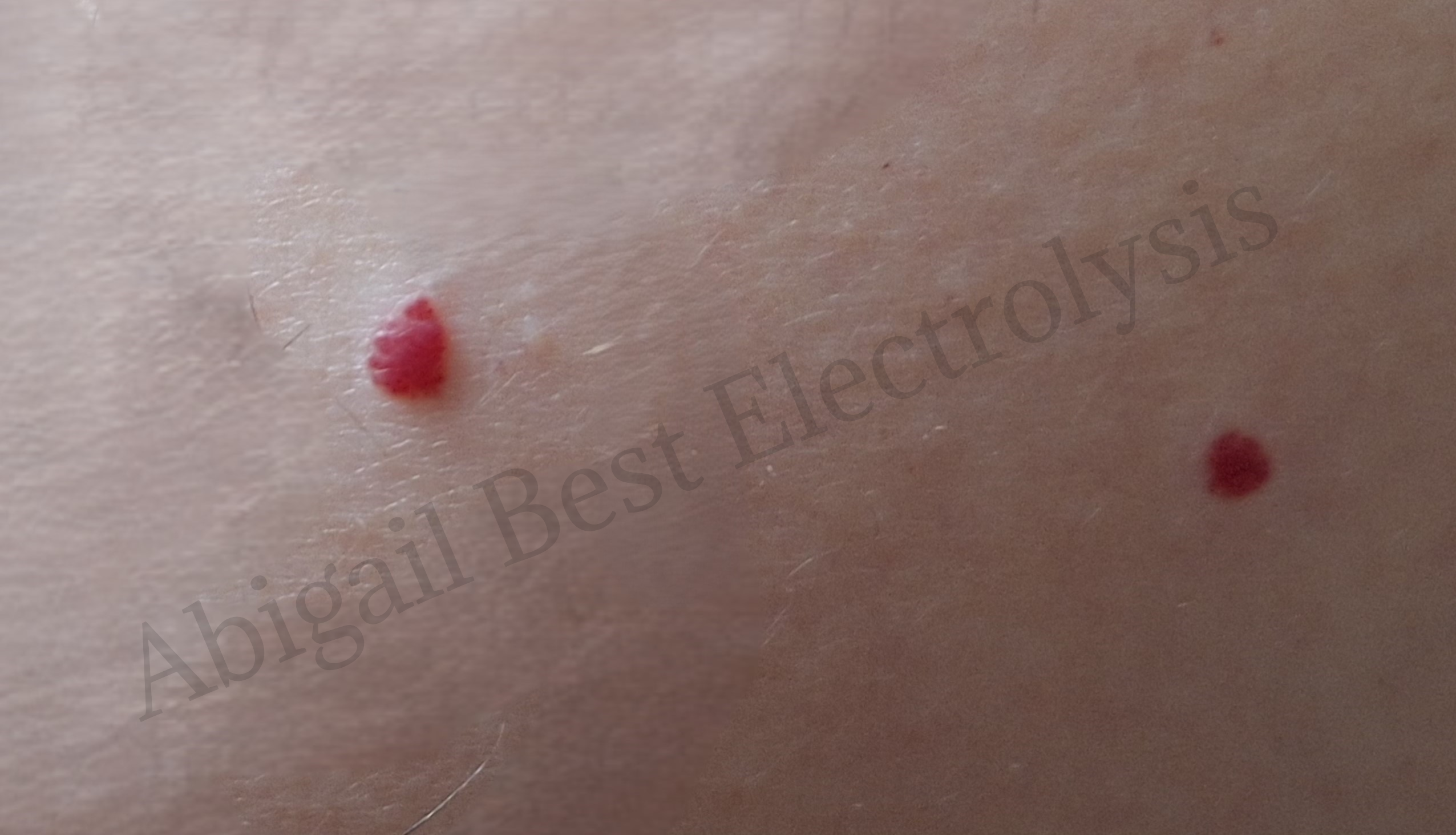 image of a cherry angioma